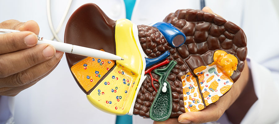Fatty liver