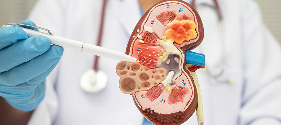 Kidney stones