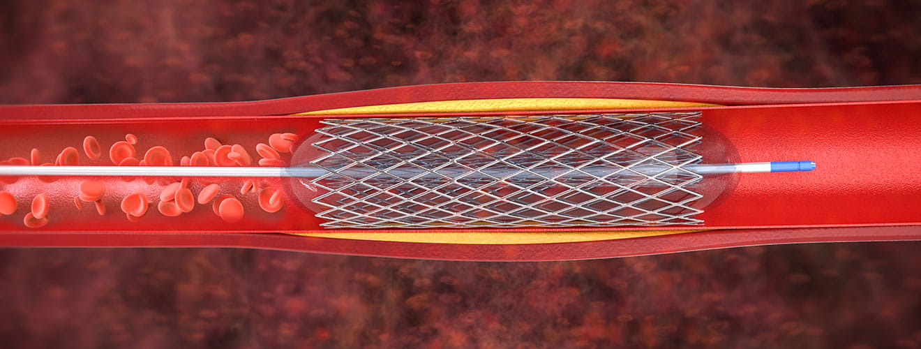 Arterial & Peripheral Vascular Interventions
