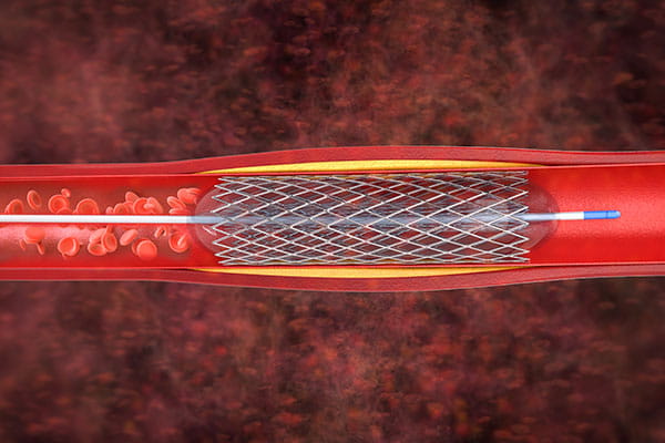 Arterial & Peripheral Vascular Interventions