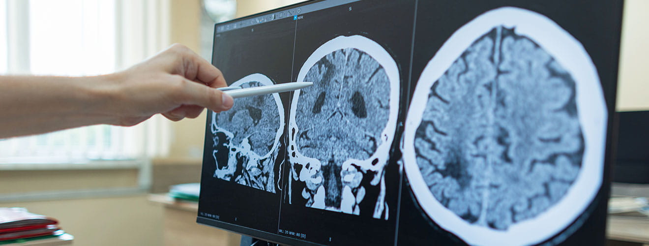 Neuro-Interventional Radiology
