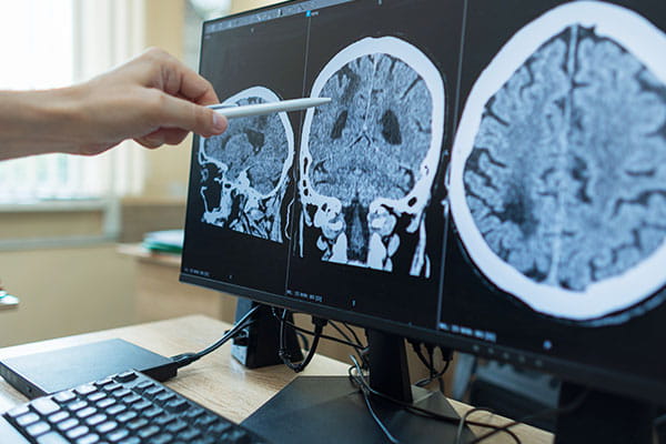 Neuro-Interventional Radiology